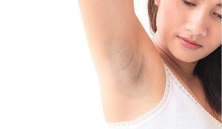Tái tạo làm sáng, Thay da sinh học vùng nách