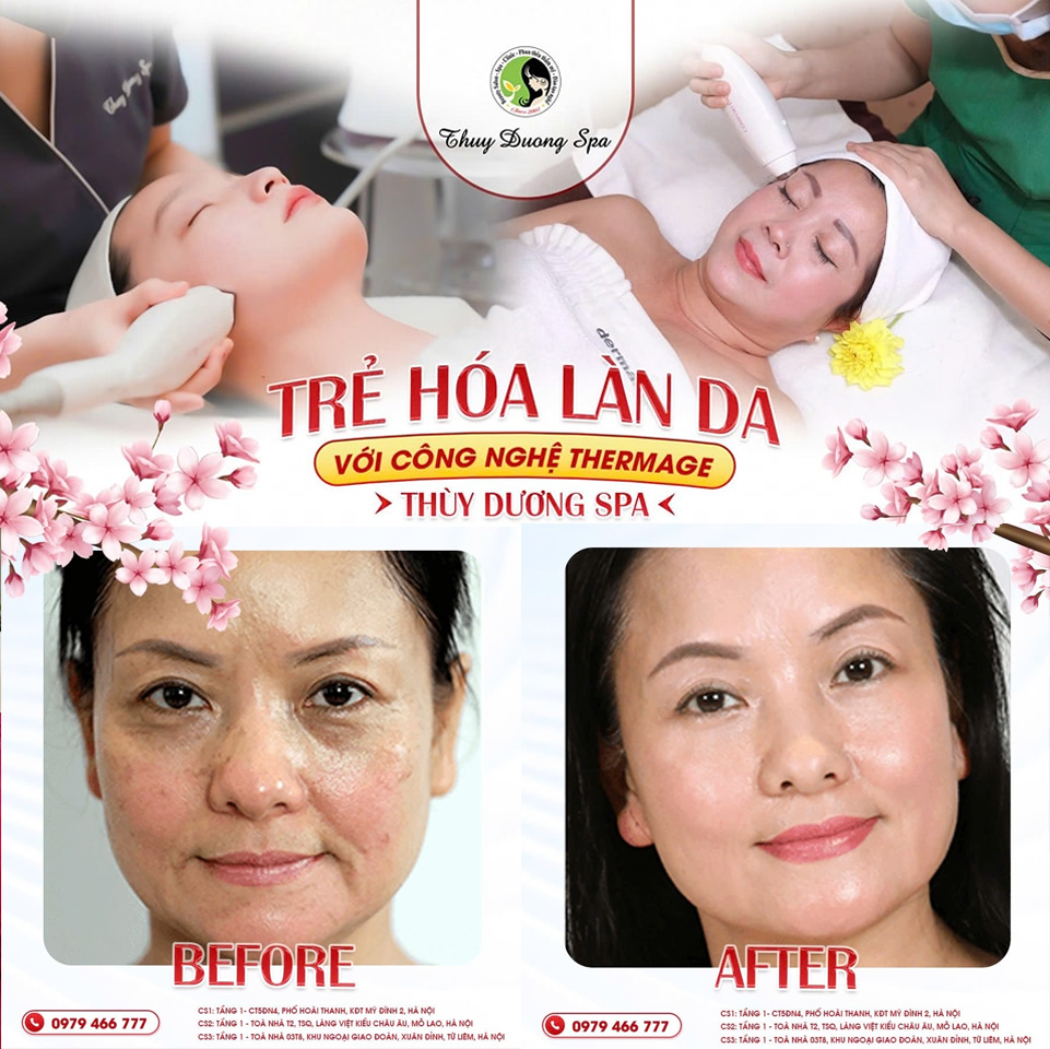 TRẺ HÓA LÀN DA VỚI CÔNG NGHỆ THERMAGE TẠI THÙY DƯƠNG SPA